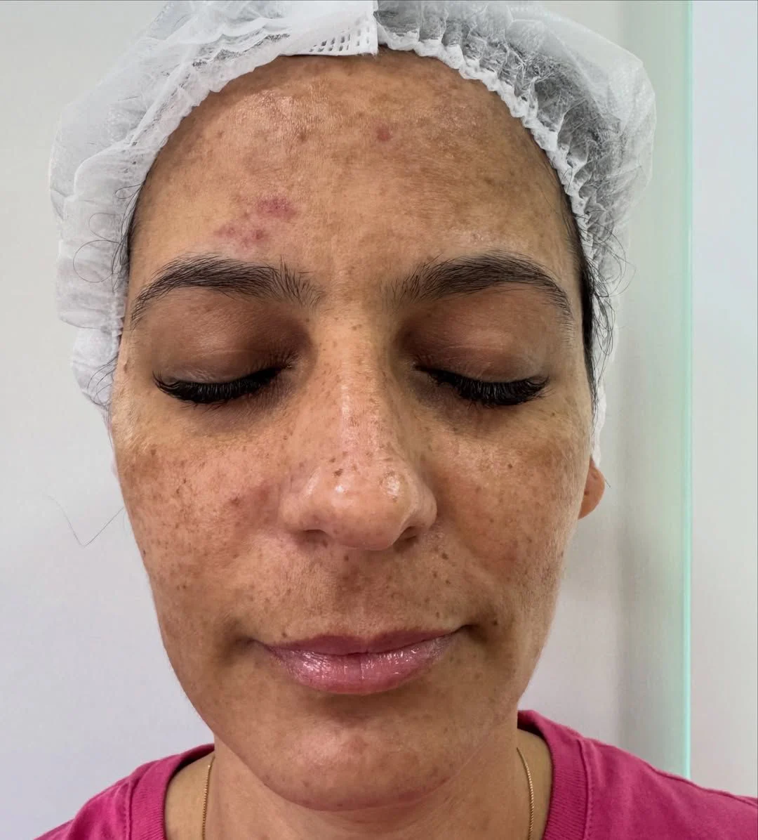 Tratamento do Melasma before