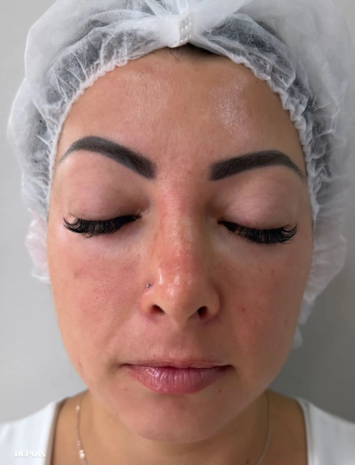 Tratamento do Melasma after
