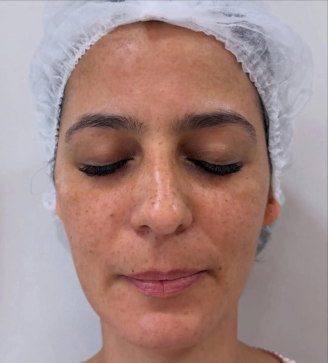 Tratamento do Melasma after