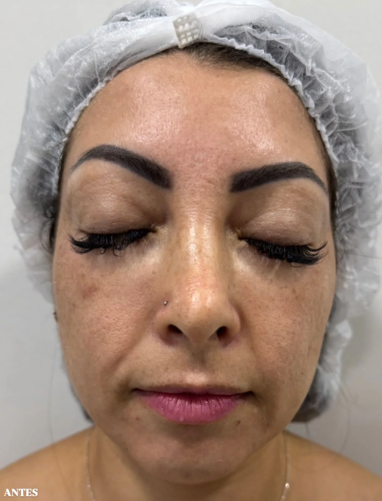 Tratamento do Melasma before